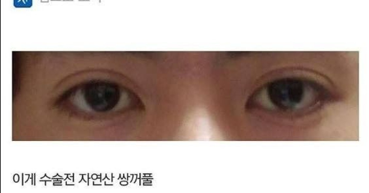 쌍꺼풀 제거 수술한 남자.Jpg | 커뮤니티