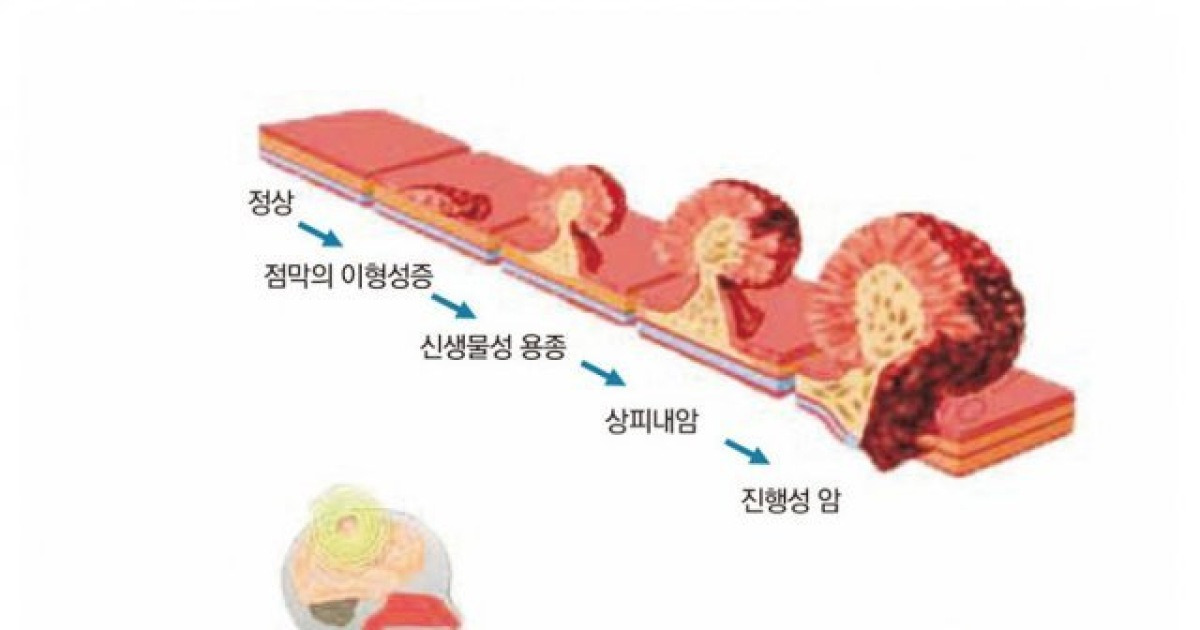 대장내시경으로 선종성 용종 제거하면 대장암 발생률 뚝 떨어진다