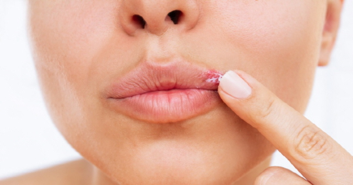 구순포진, 입술포진 빨리 낫는법, 8