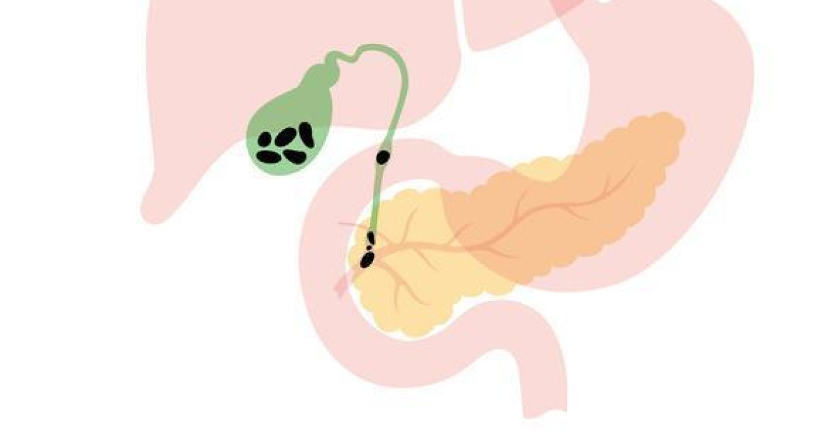 담석 유발하는 생활 습관은? “기름진 음식 줄이고, 규칙적으로 식사해야”