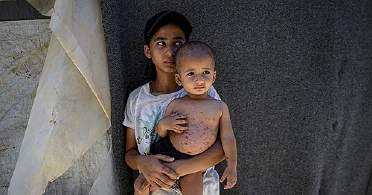 Israel Palestinians Skin Diseases