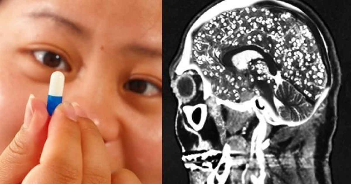 살 좀 빼려고 '이 약' 먹었다가 기억 잃었다…끔찍한 부작용 겪은 여성