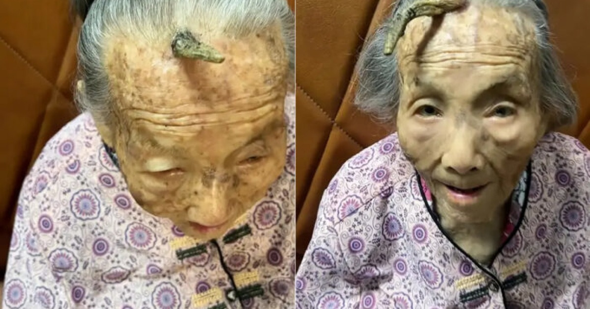 The Baffling Bump: 107-Year-Old Grandma's Mysterious 10cm Forehead Horn Sparks Curiosity and Concern - News Directory 3