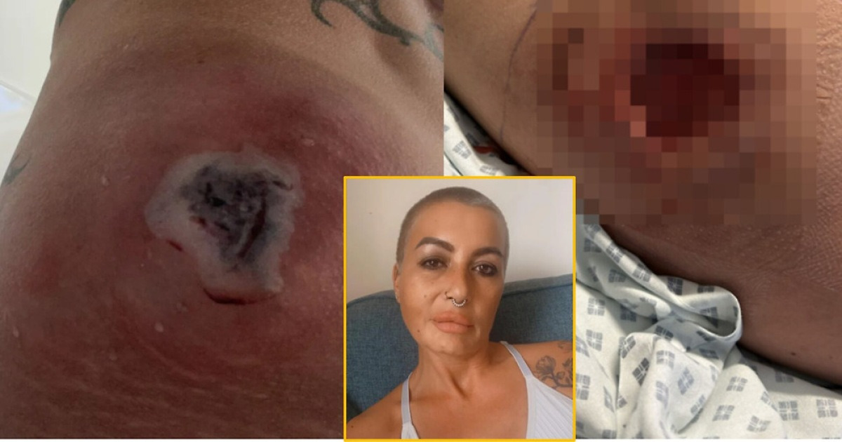 “The flesh on my buttocks rotted and pus oozed out”… What happened to the woman who almost died after doing this on both sides?