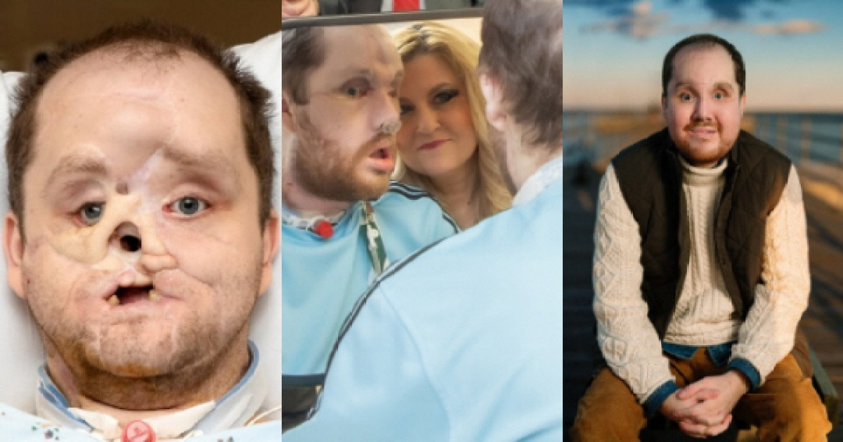 얼굴 잃었던 미국 남성의 반전…안면인식으로 새 삶