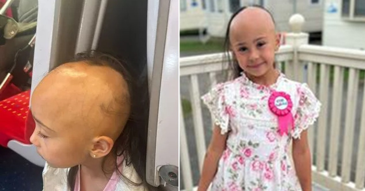 「後頭部に髪の毛のストランドだけ」…7歳の少女、どうして脱毛が？