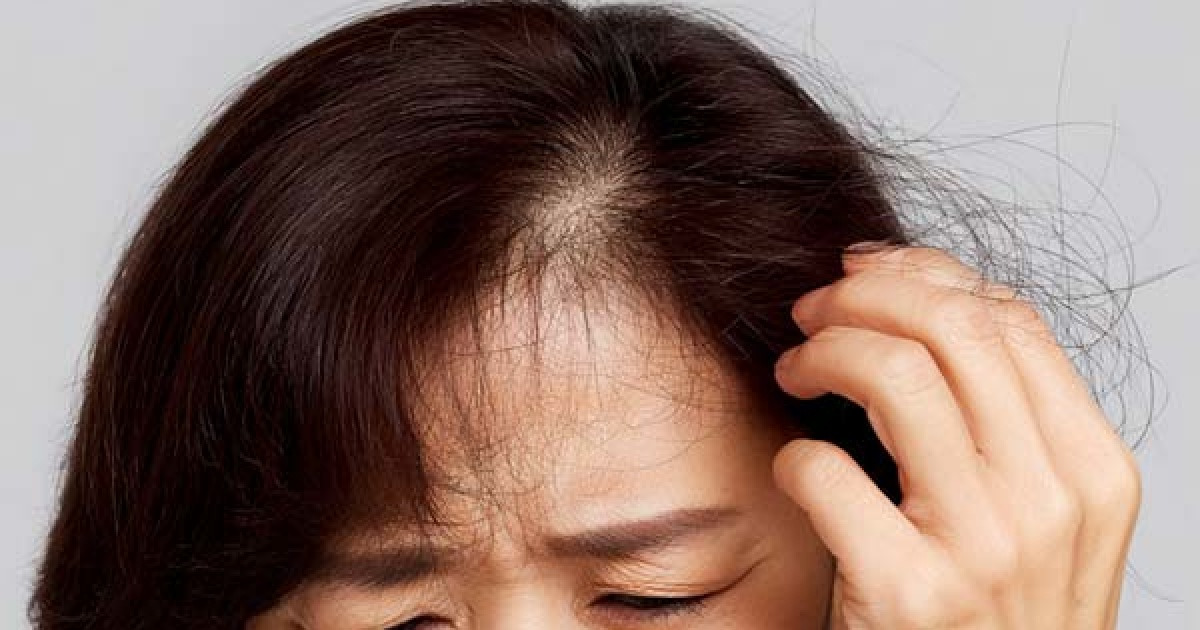女性の脱毛、生活の質、うつ病の患者。カウンセリング治療