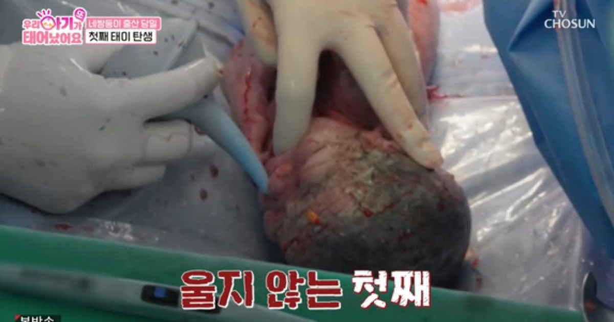 네쌍둥이 출산, 의료진 20명 투입됐지만..4명 다 울음 없이 중환자실行 ('우아기')[종합]
