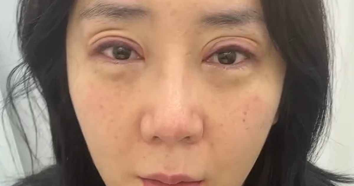 허안나, 코 수술 한달만 이번엔 눈 시술 받았다‥퉁퉁 부은 충격 비주얼