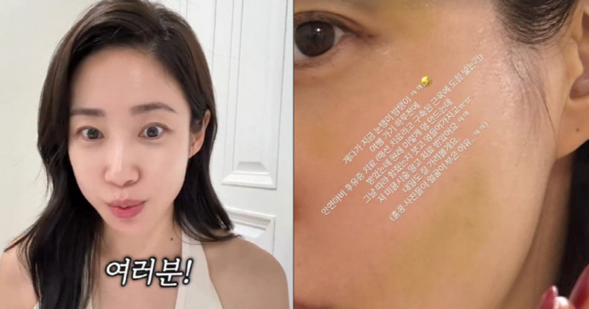 최희, 안면마비 후유증 치료 중 '악재'…"얼굴 피멍에 붓기까지"