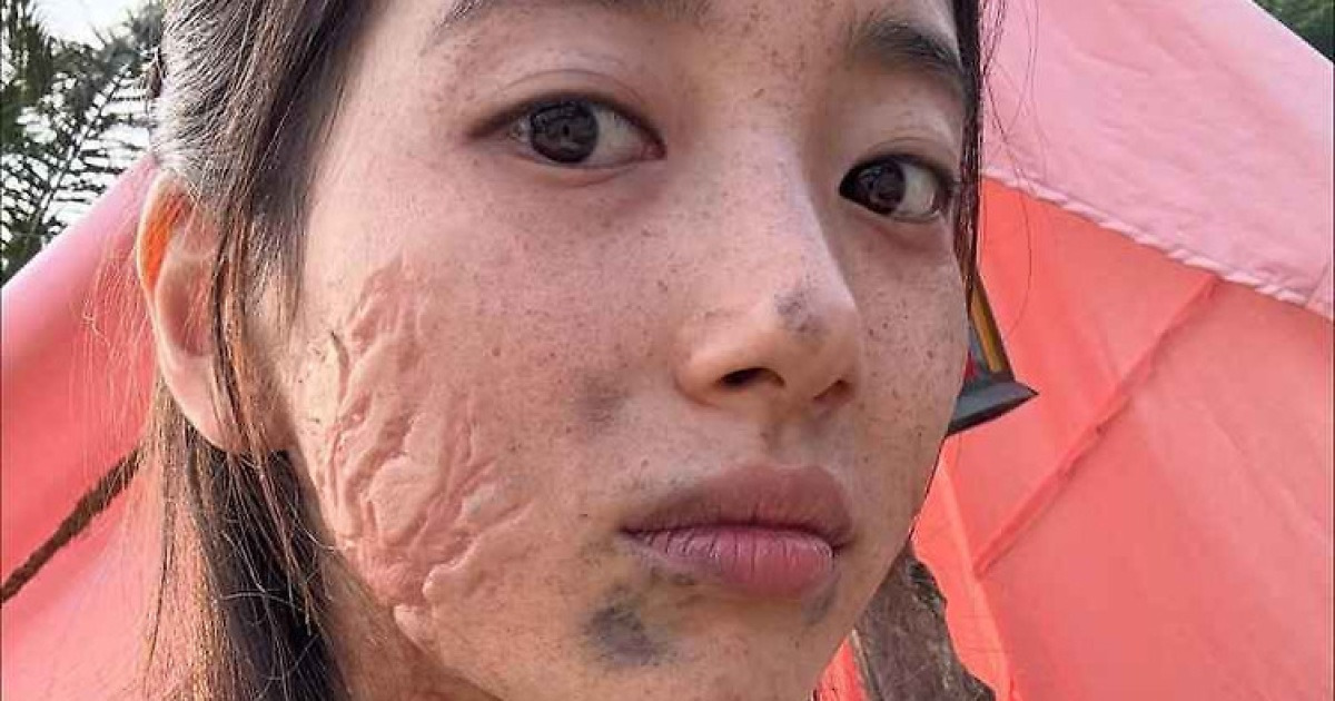 수지, 얼굴 뒤덮은 주근깨에 흉터 있어도 예쁘기만…훈훈한 '다지니' 현장
