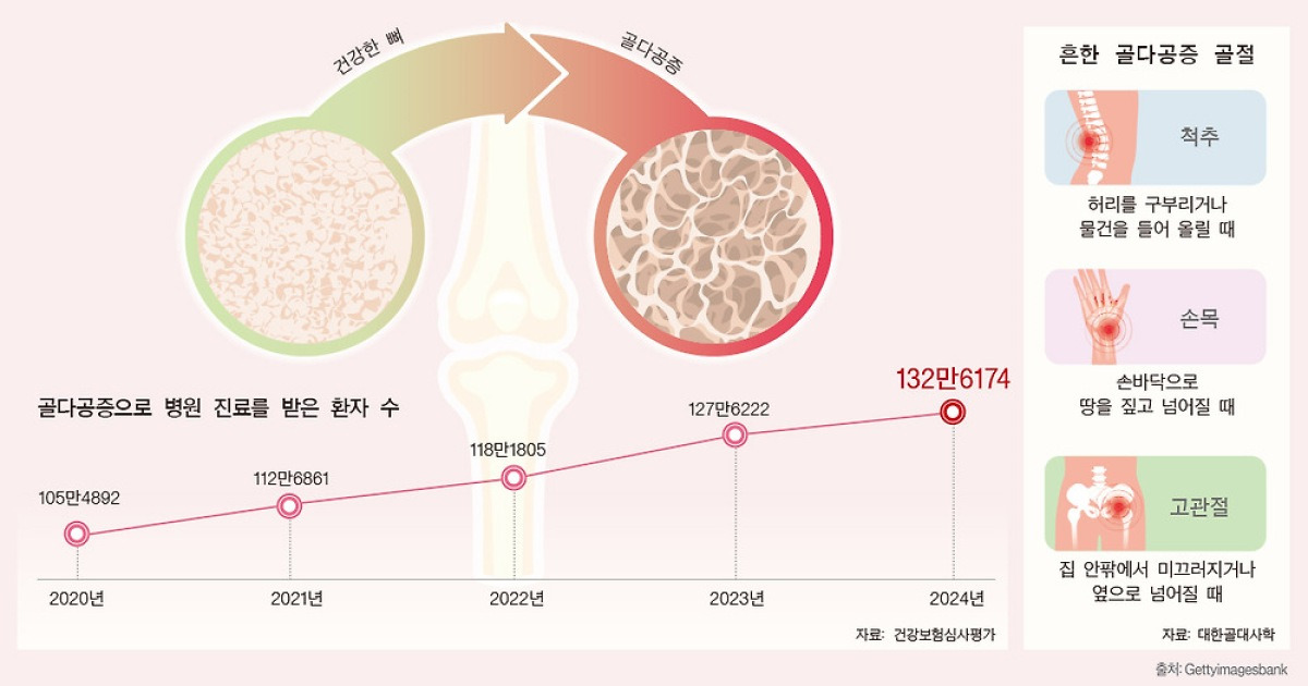 소리 없이 찾아오는 골다공증, 키 줄고 허리 굽어지는 게 단서 [Health&]