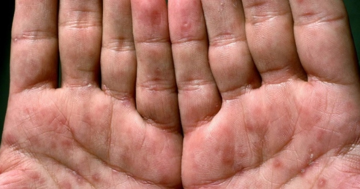 「手のひらが赤い」は最悪の「死の病」であることが判明…今、状況は変わり、全世界が揺れている