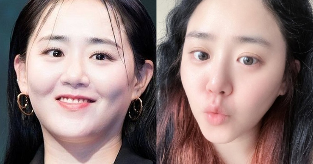 '국민 여동생' 문근영, '급성구획증후군 극복→다이어트 성공' 근황 [RE:스타]