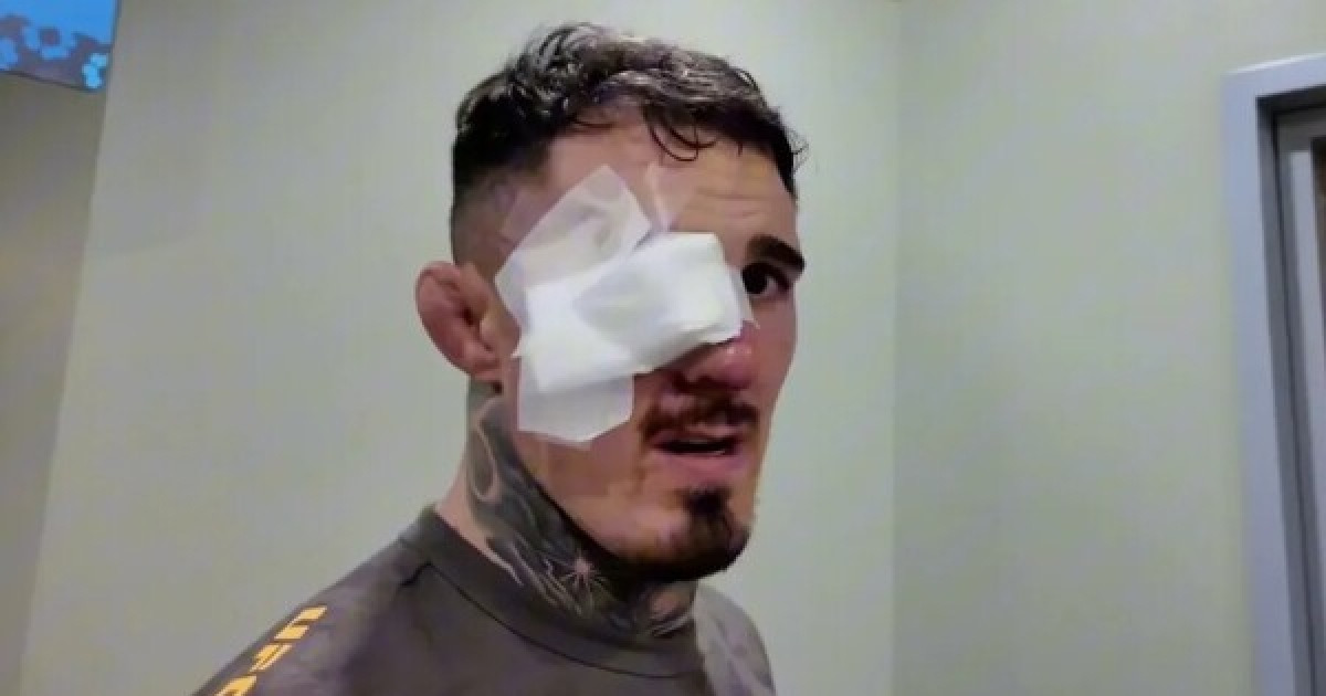 "오른쪽 눈 전혀 보이지 않아, 왼쪽 눈도 시력 절반 잃어"...아스피날, 눈 찔림 공격당한 후 "여전히 상태 좋지 않아"