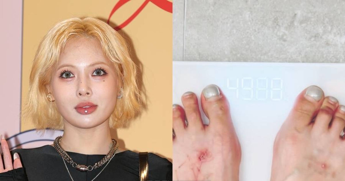 현아, 임신설에 다이어트→49kg 진입…타투 지운 상처투성이 발 '눈길'
