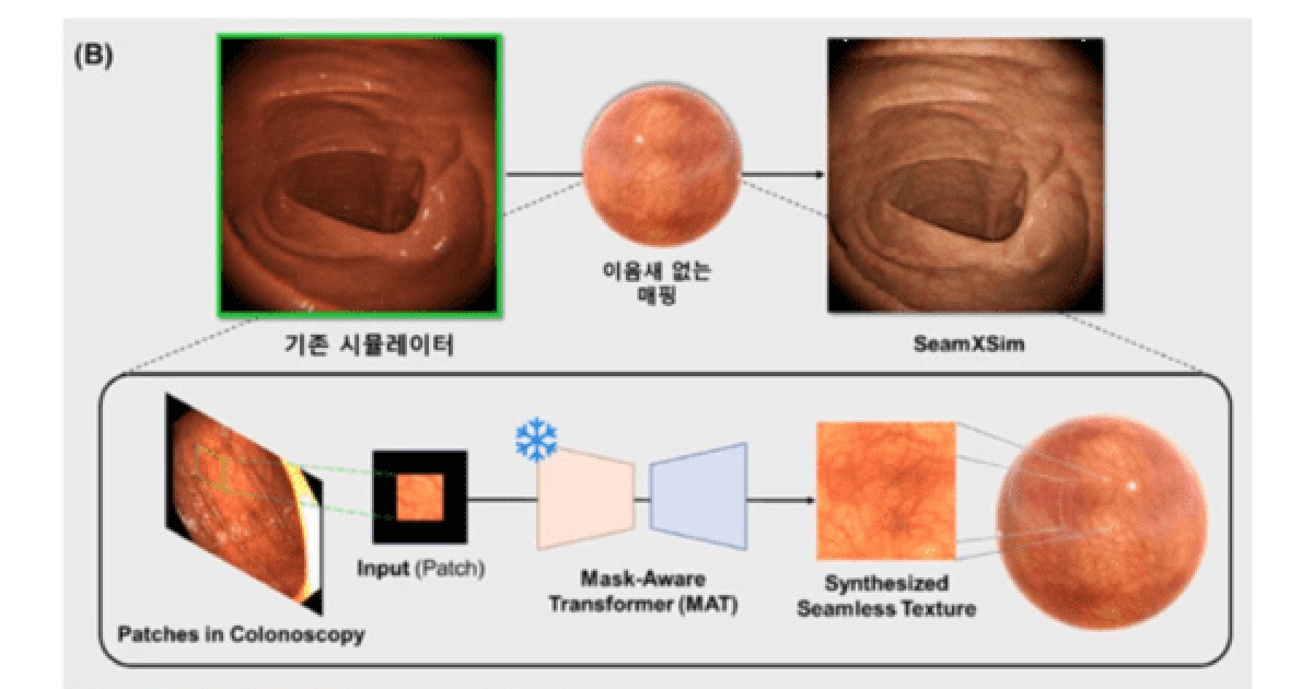 용종 발견률도 높인다? 서울대, AI 기반 '가상 대장내시경' 개발