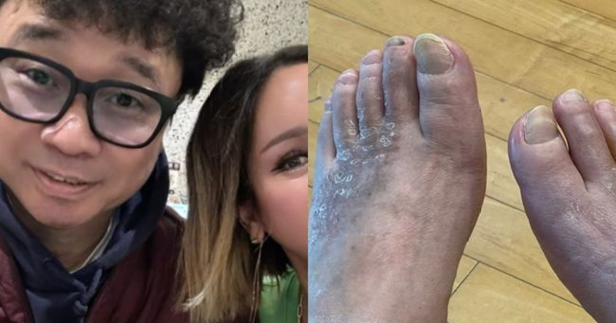 '하반신 마비 25년' 강원래, 심각한 발 상태..김송 “통증도 못 느껴" [핫피플]