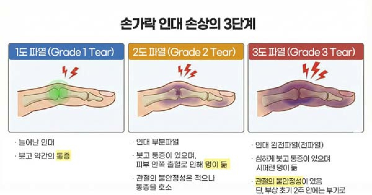 간과하기 쉬운 손상 – 손가락 인대 손상 [곽상호의 손·손목 이야기]