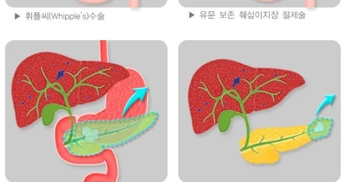 췌장질환 치료에 배에 구멍 하나만 뚫는 ‘이 수술법’··· 수술시간은 줄이고 만족도 높여