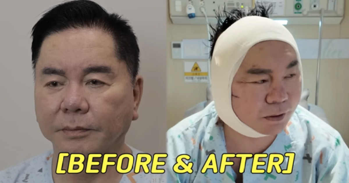 ‘67세’에 다시 카메라 앞..심형래, 안면거상 수술 근황 공개 ('영구TV')