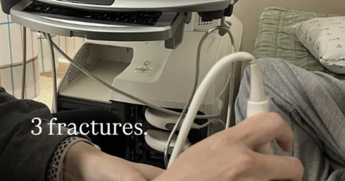 '금메달' 최가온, 골절상 진단 나왔다…SNS에 진단 결과 암시→'투혼의 올림픽 챔피언' 더더욱 감동 [2026 밀라노]