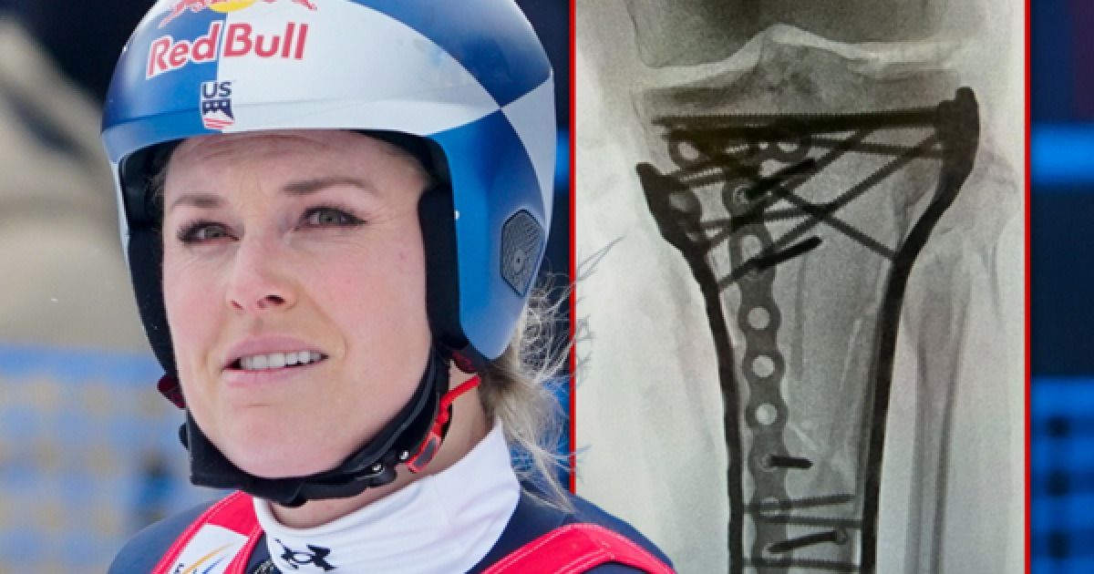 '13초 만에 추락→6시간 대수술'...몸에 나사·플레이트 박는 고통 견딘 '올림픽 스타' 린지 본, 아픔 딛고 전한 '희망찬 근황'