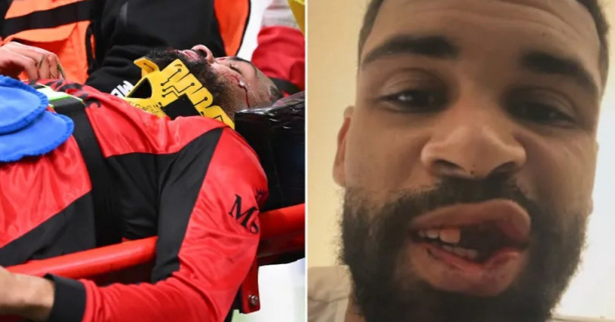 로프터스-치크, 충돌로 치조골 골절... 8주간 경기 출전 불가