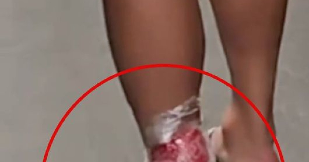 이래놓고 항의를 해? 손흥민, 아킬레스건 직격→얼음 대고 절뚝절뚝..."발에 자국 남아있더라" 위험한 태클에 부상 우려