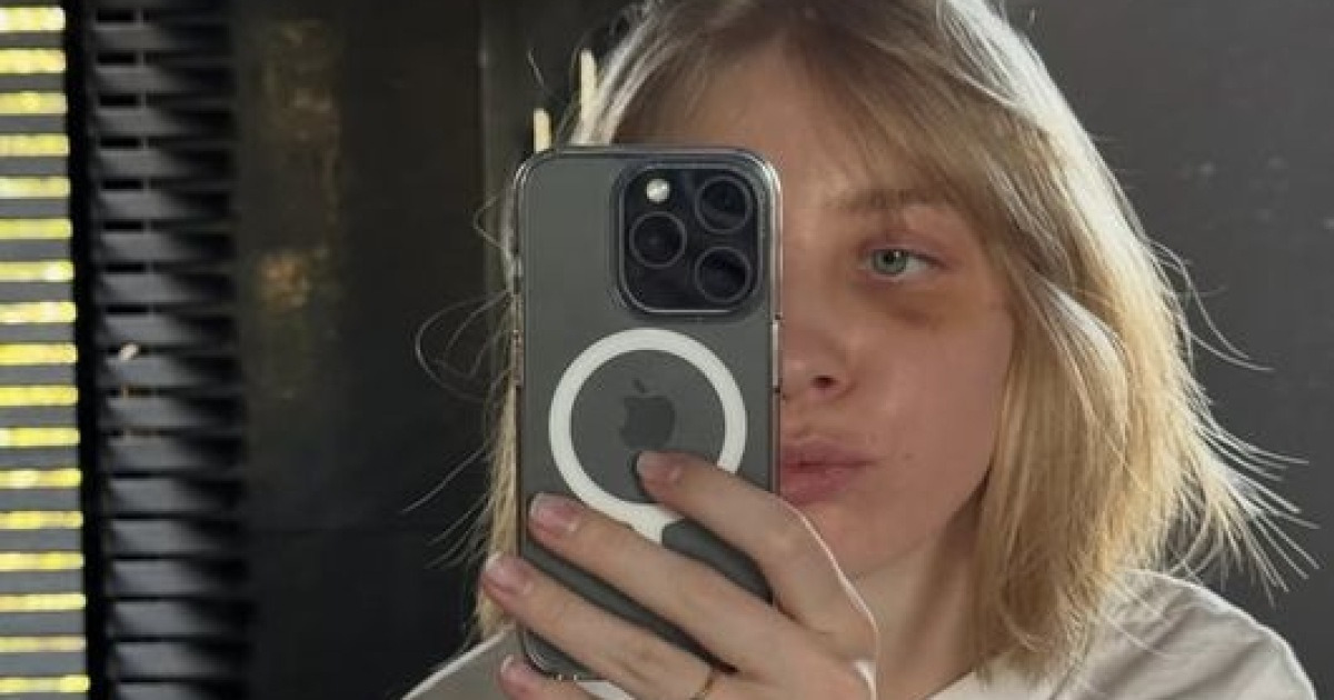 '스케이트 날에 안면 충돌' 피 철철 흘린 女 선수, 손흥민 받았던 그 수술 받았다...'얼굴 절반' 가린 근황 공개 "또 한 번 컴백홈"