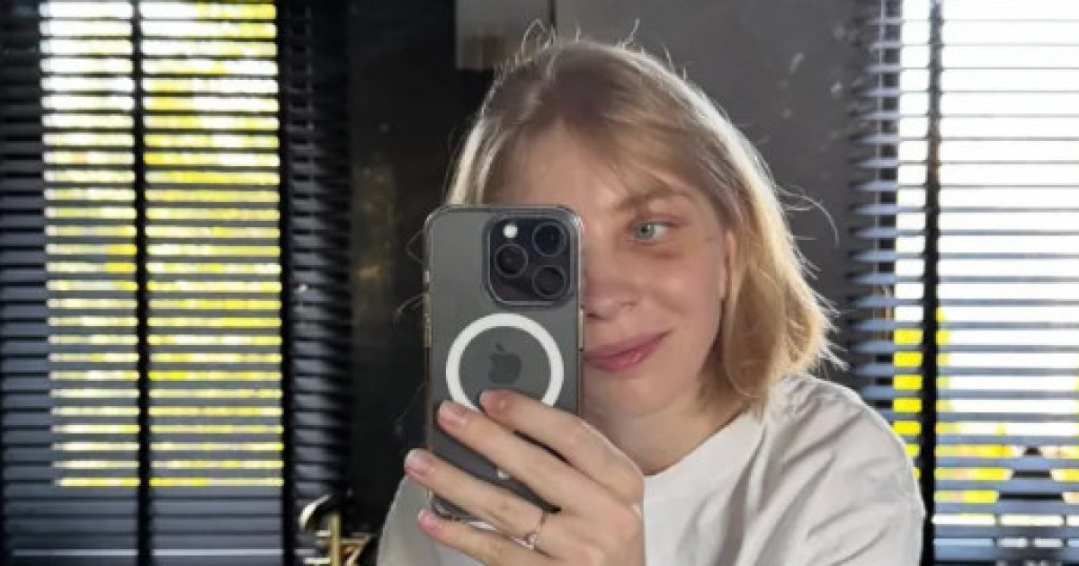 스케이트 날에 실명 위기 "눈 밑에 티타늄 박았다" 고백... 女 쇼트트랙 스타 '가려왔던 흉터' 생방송서 공개