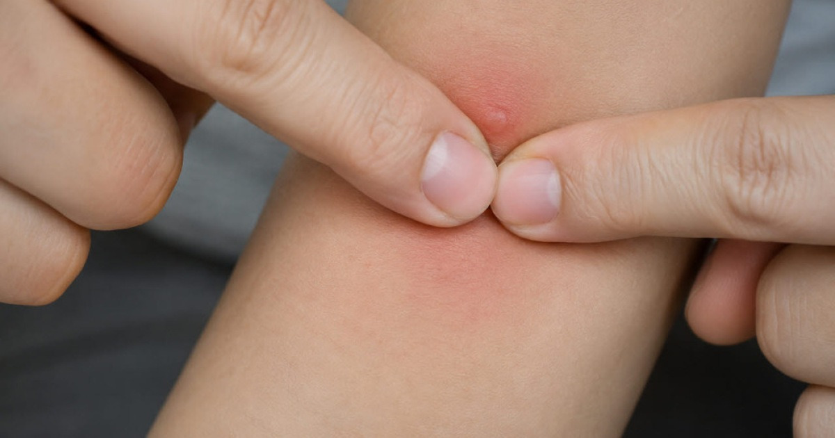 Stop Scratching Insect Bites: Risks of Scarring, Pigmentation, and Infection