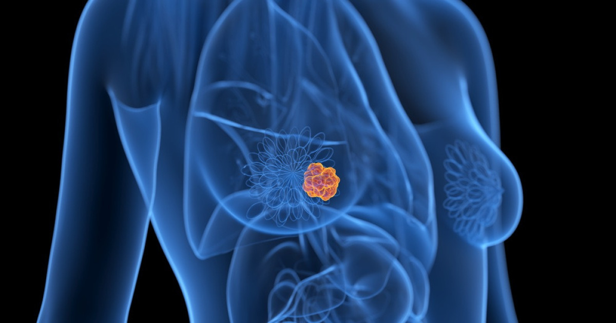 Breast Cancer Treatment: Why Chemotherapy May Come Before Surgery