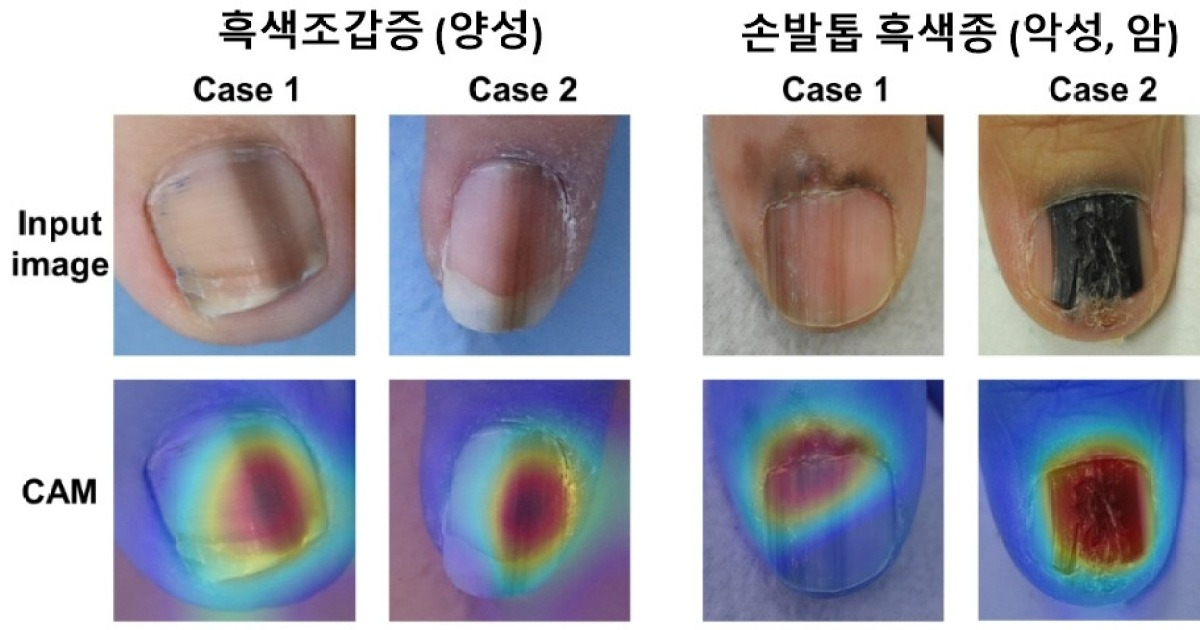 손발톱 검은 줄, 흑색종일까 아닐까…AI가 가려낸다