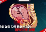 ‘10만 분의 1’ 자연임신 겹쌍둥이, 자궁 터질 위기 “아기가 나가버려”
