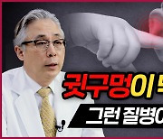 [질병백과 TV] 귓구멍이 막히기도 한다.. 수술로 치료 가능해졌다