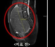 20cm 거대자궁근종도 수술 없이 치료