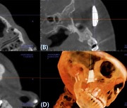 3D프린팅으로 만든 '인공 광대뼈', 효과·안전성 입증돼