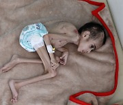 작고 마른 이 아이는 일곱살에 겨우 7kg..내전 속에 고통받는 예멘 아이들