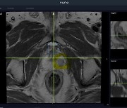 뷰노, 전립선 자기공명영상 분석 솔루션 식약처 인증받아
