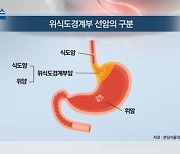 [쿠키건강뉴스] 위·식도 경계암 특성 규명.."치료법 진전 기대"