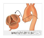 [질환 돋보기]대동맥, 시작지점 확장시 다른 부위보다 더 위험