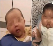 중국 호르몬 크림, 아기 얼굴 '퉁퉁' 붓는 부작용 유발