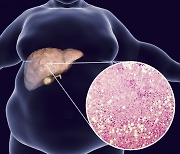 "지방간 있으면 담낭 체크해야"..'암'될 큰 용종 위험 2.1배 ↑