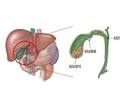 "지방간 있으면 담낭 용종 발생 위험 1.4배 높아져"