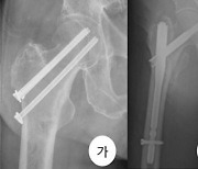 겨울철 노인 건강 위협하는 '고관절 골절'