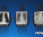 [사진] 건강한 폐 vs 흡연자의 폐 vs 코로나 환자의 폐