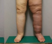 다리 팽창하는 '중증 림프부종', 초미세혈관 수술로 개선