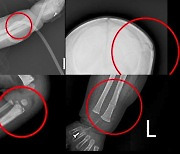 "뼈 손상 시기 다 달라"..분리 치료받자 '방긋'
