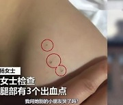 3살 아이 온몸에 바늘 자국만 29개..中 유치원 아동학대 논란
